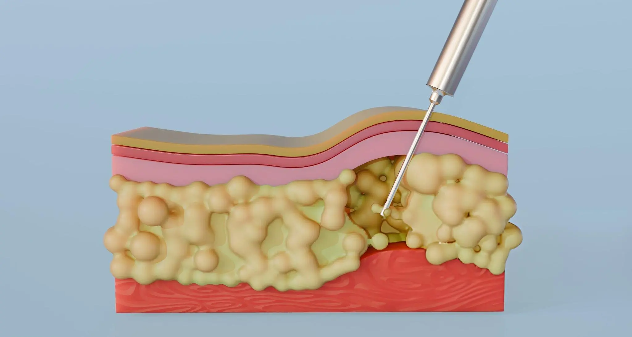 Illustration of syringe entering fat layer—representing minimally invasive fat-derived stem cell injections for joint repair in Mexico
