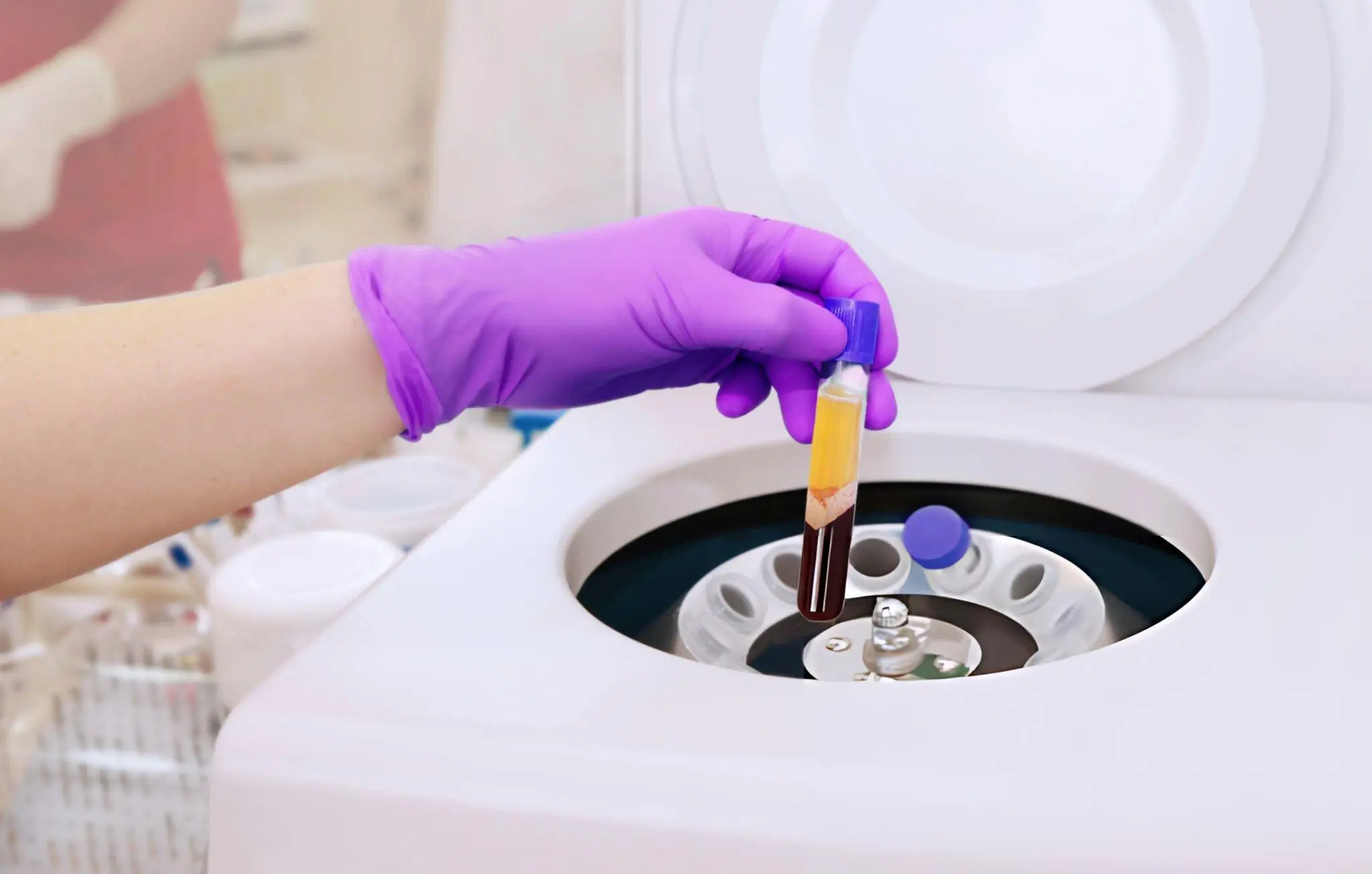 Gloved hand holding centrifuged blood sample—representing stem cell therapy research for type 1 and type 2 diabetes treatment