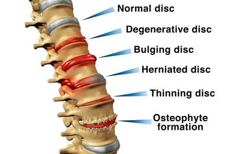 herniated disc