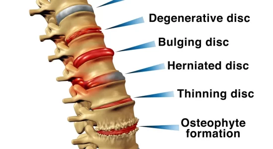 herniated disc