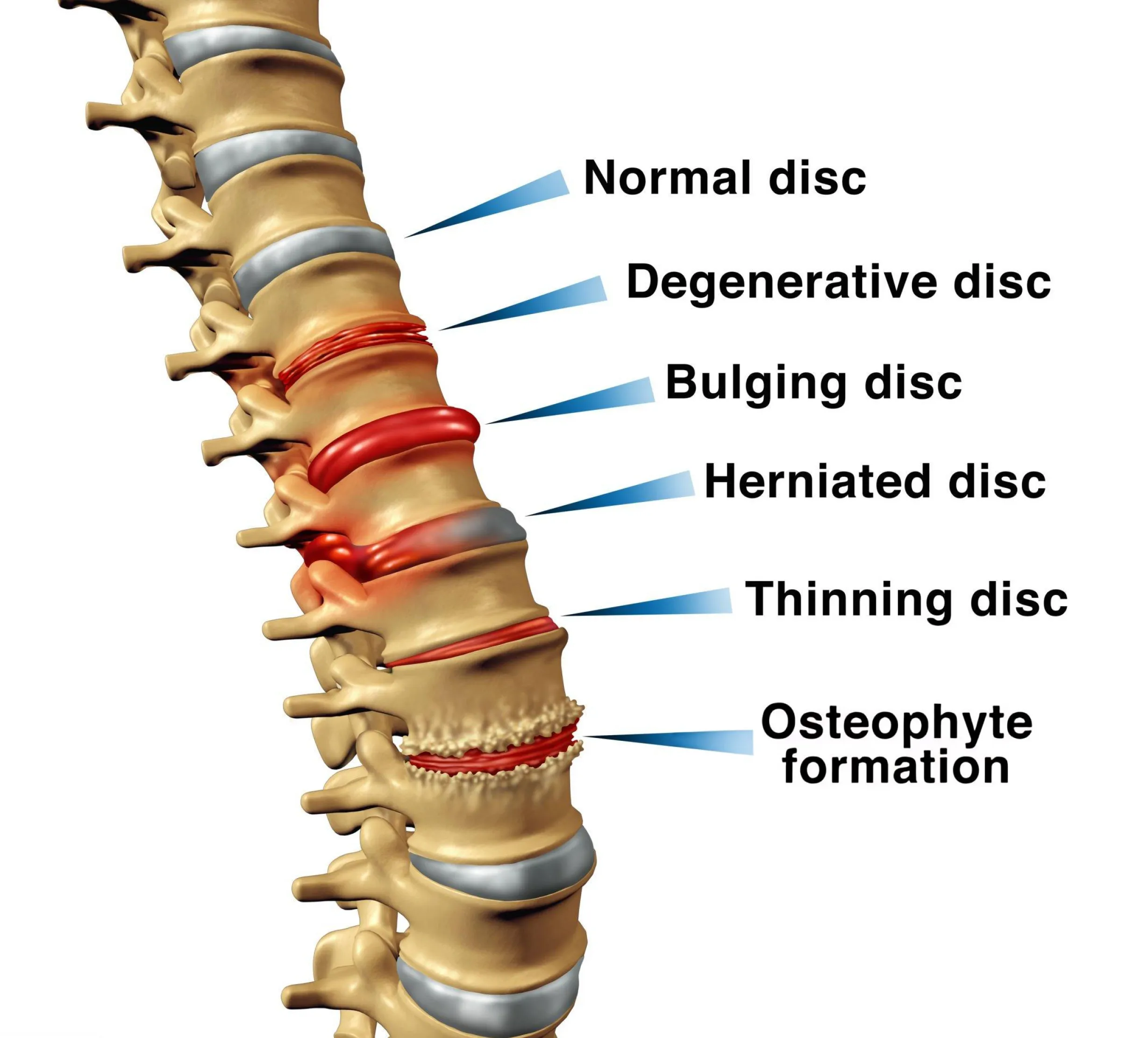 herniated disc