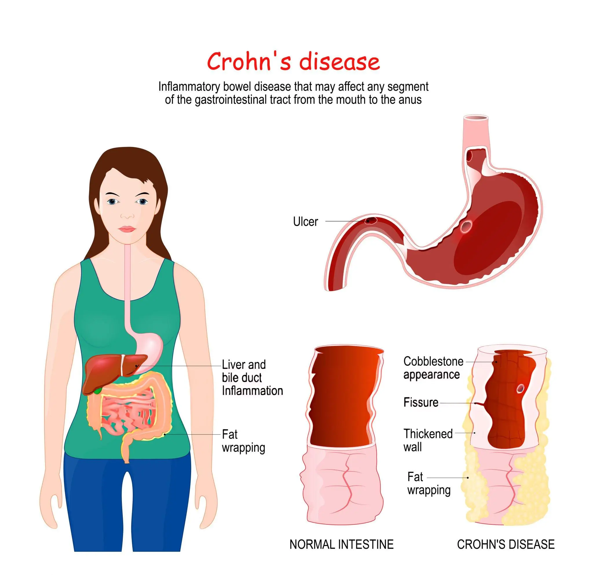 Stem Cell Therapy For Crohns Disease Ulcerative Colitis R3 Stem